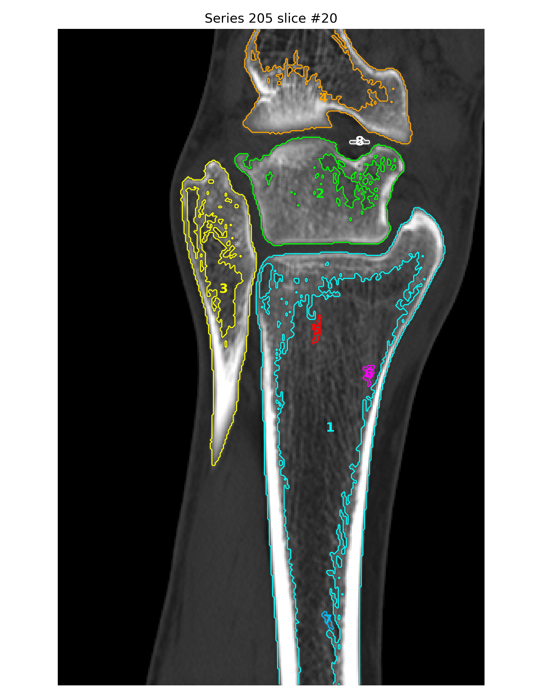 Coronal component labels