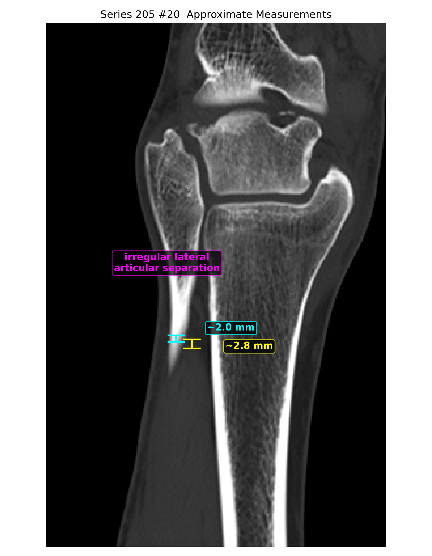 Coronal annotated measurement