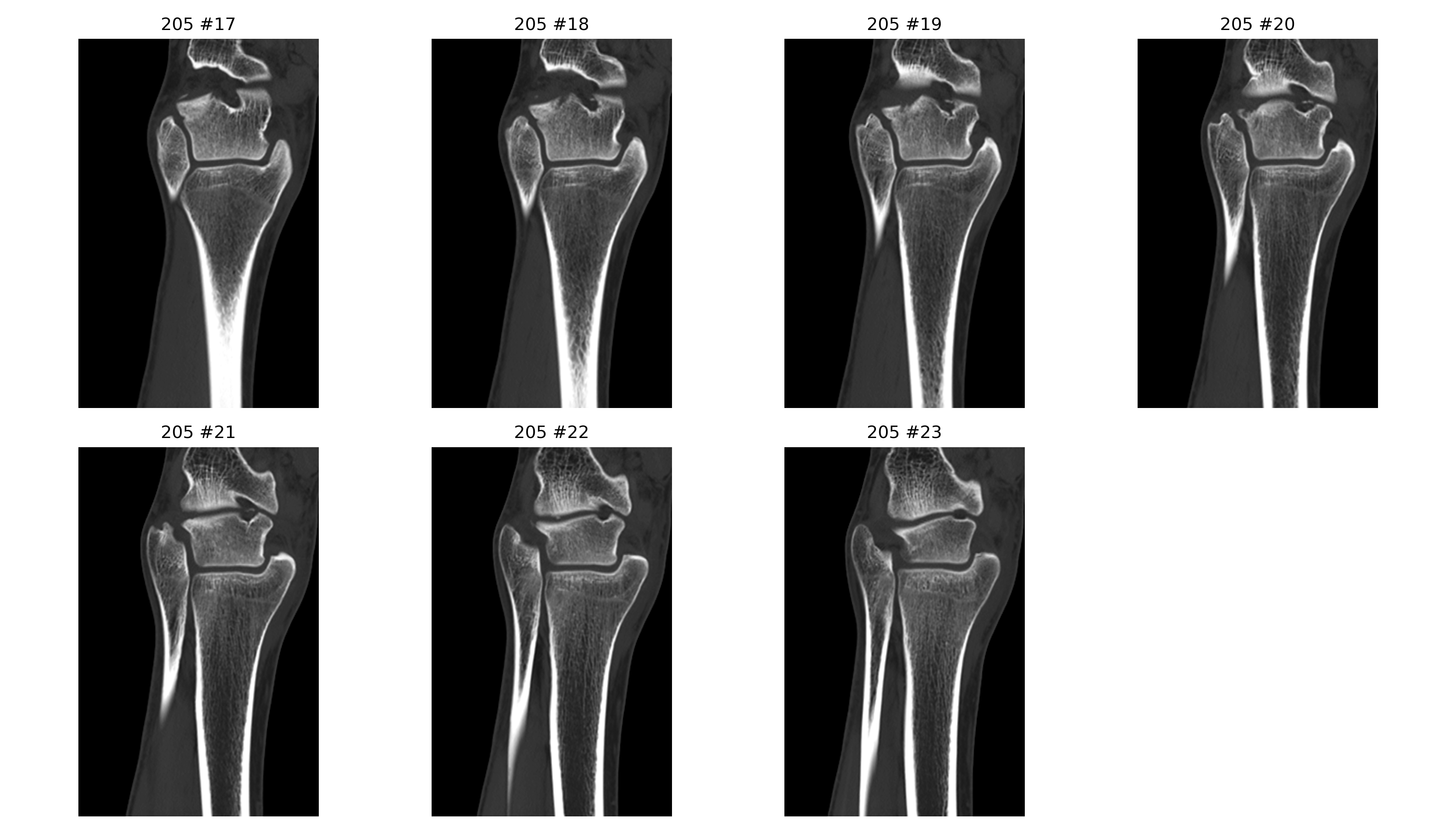 Coronal zoom measure
