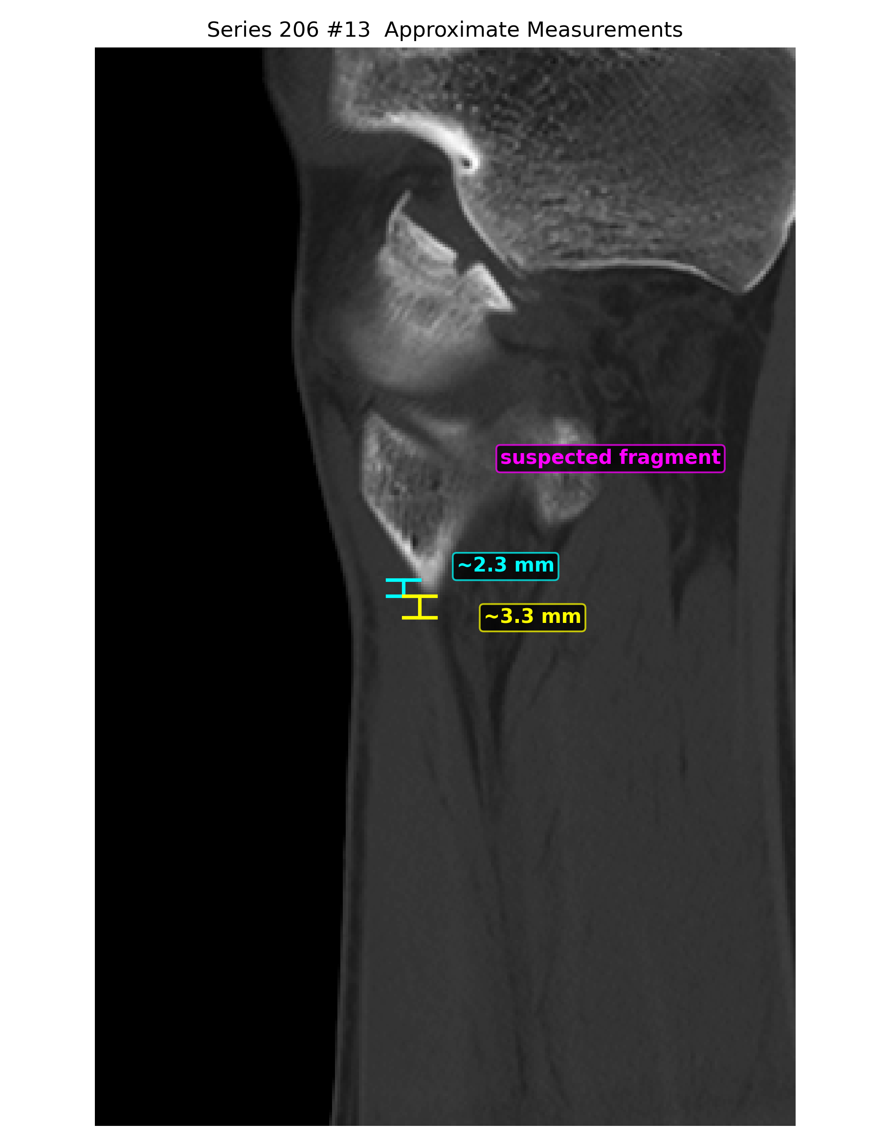 Sagittal annotated measurement
