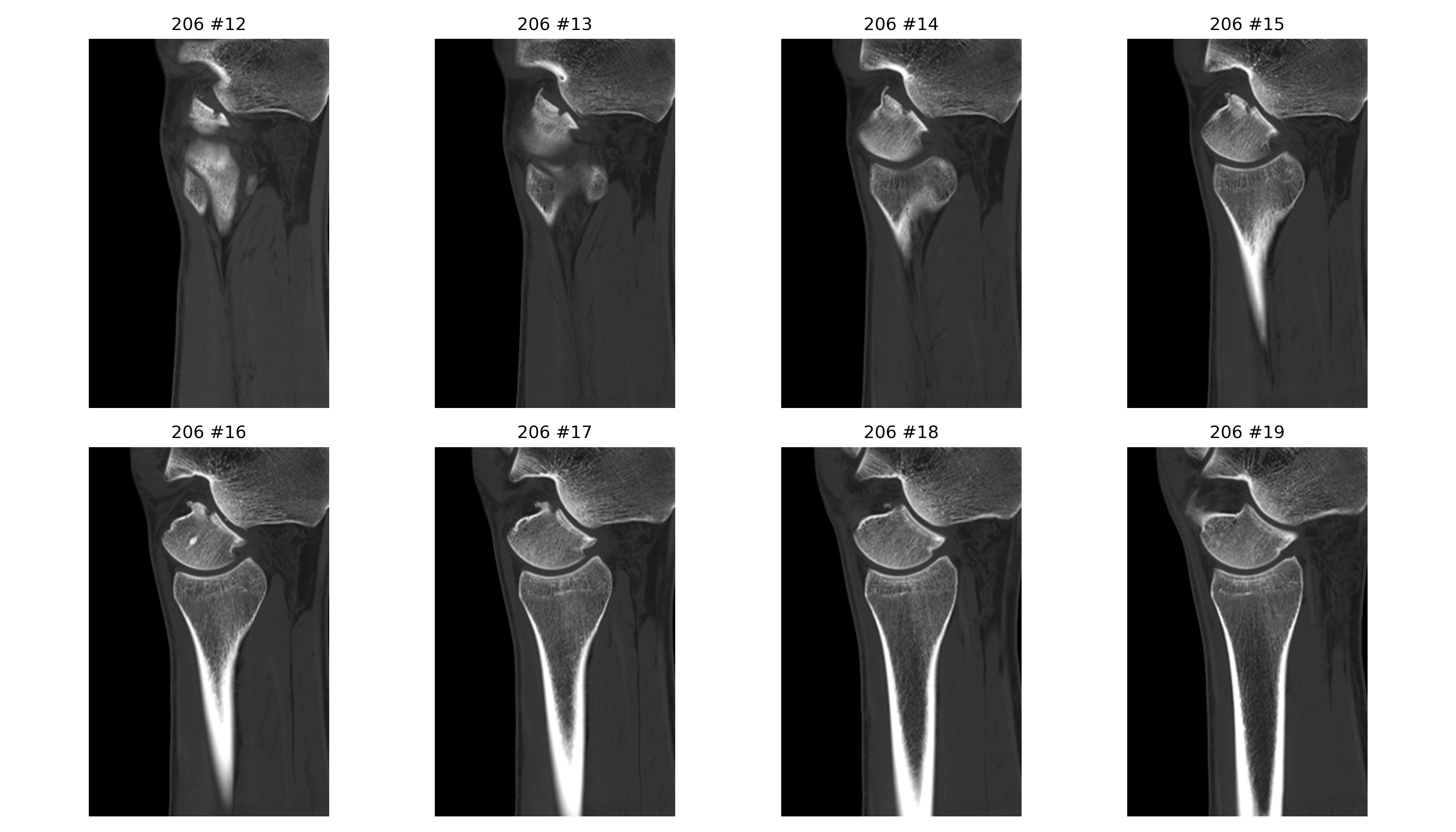 Sagittal zoom measure