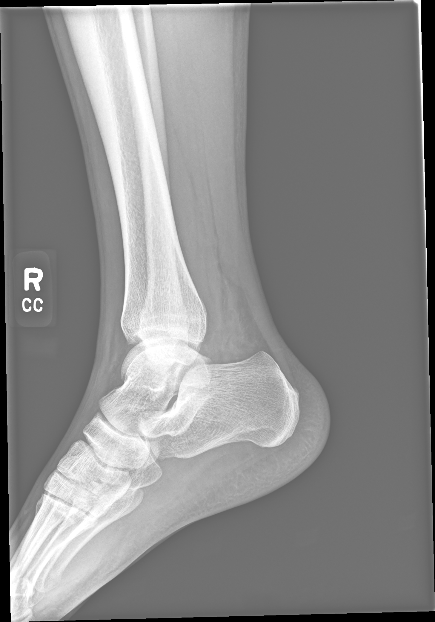 X-ray lateral view